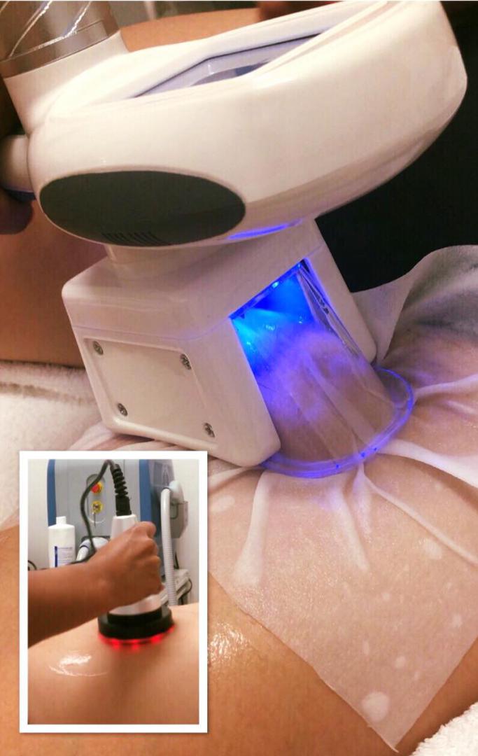 Cryolipolyse et Lipocavitation