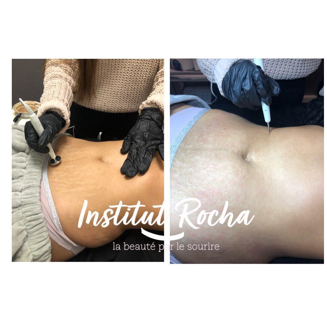 Traitement vergetures