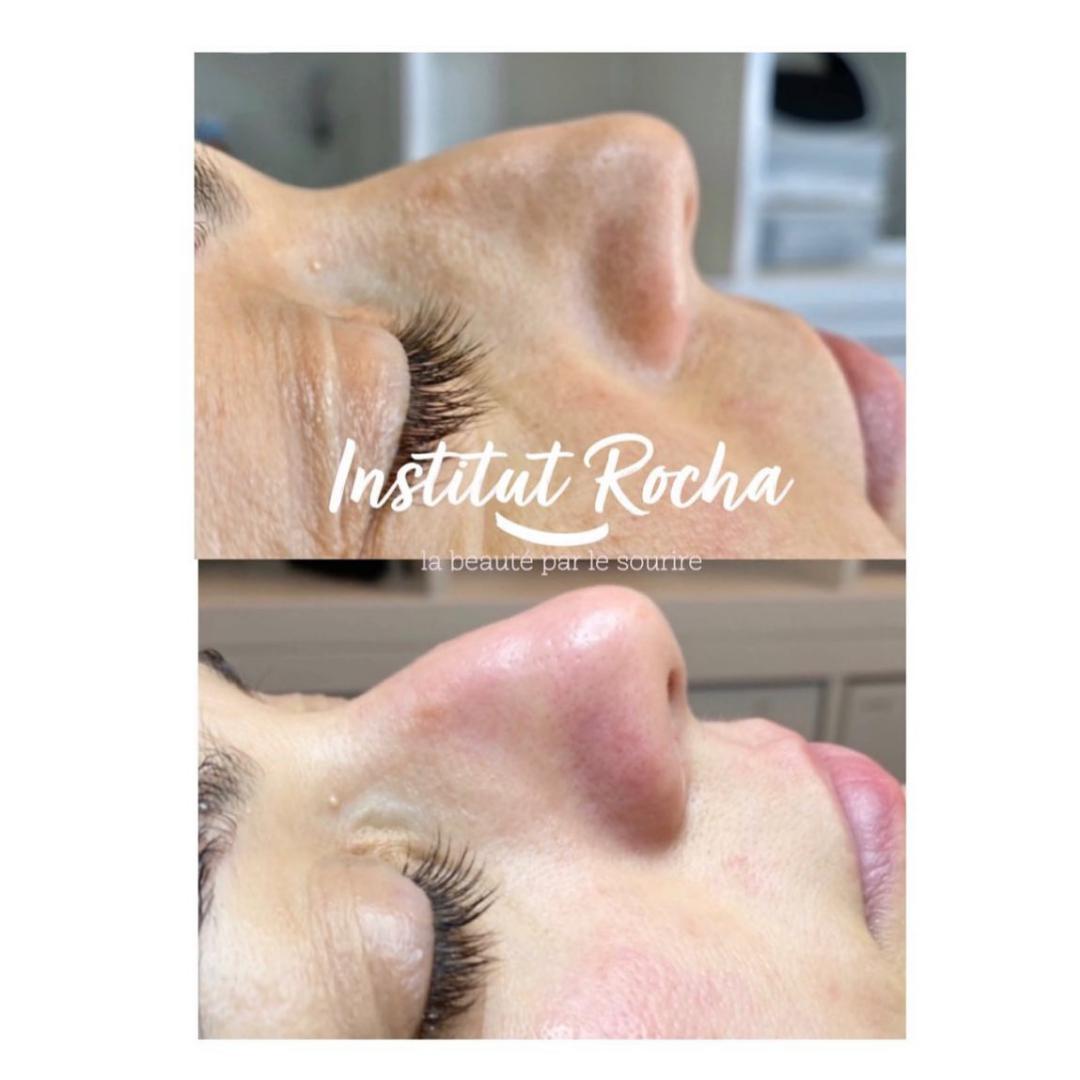 Nettoyage de peau en profondeur