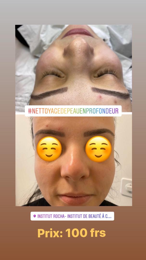 Nettoyage de Peau en Profondeur