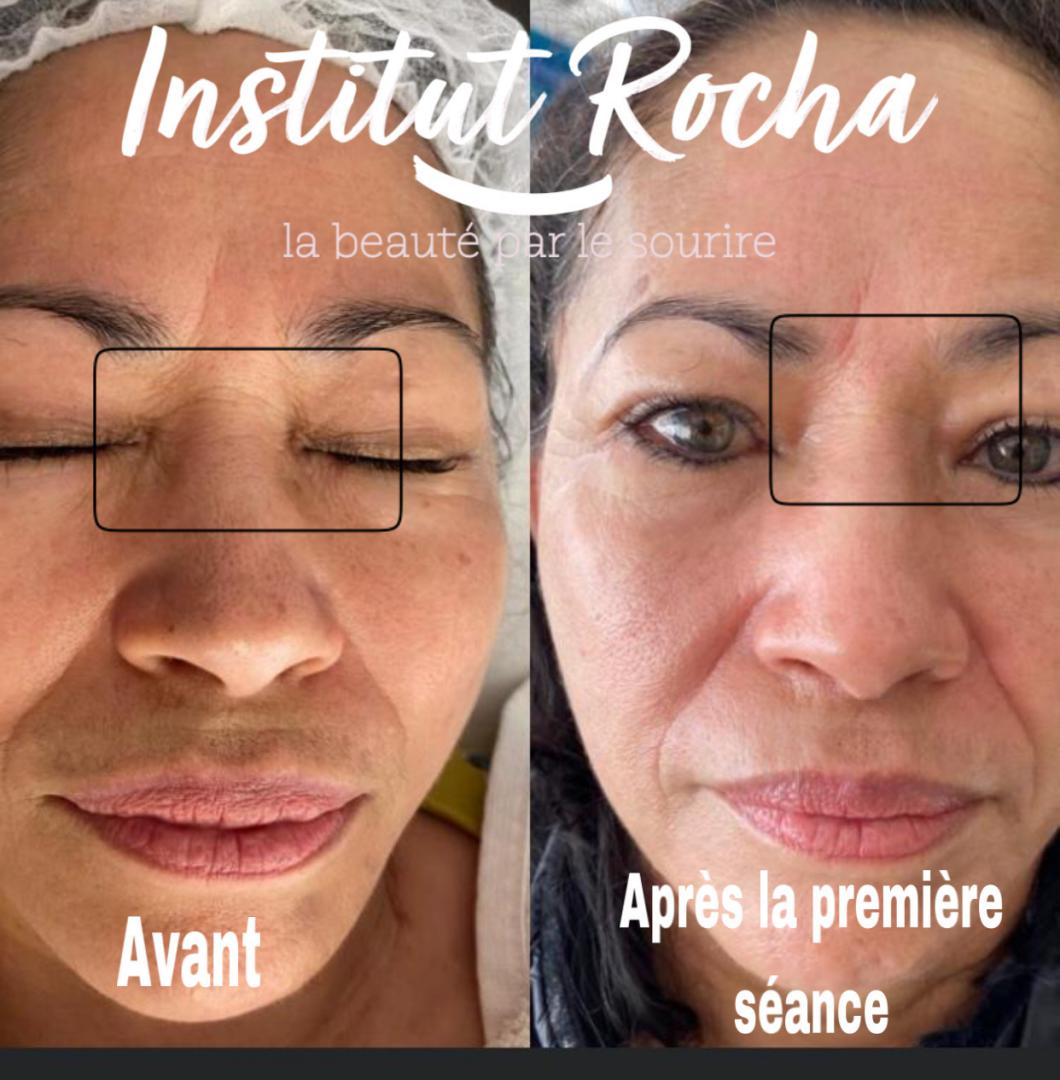 Dermatude (Traitement anti-âge)