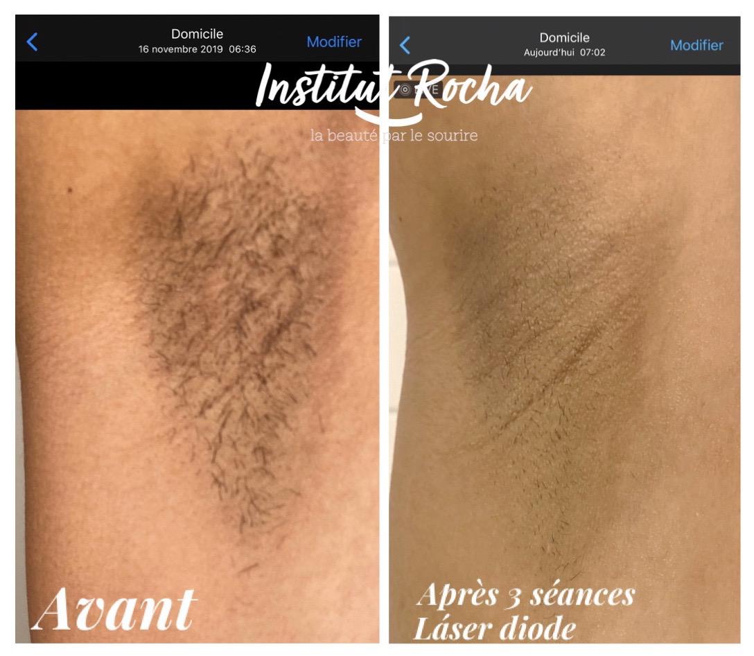 Epilation laser Diode (sans douleur)