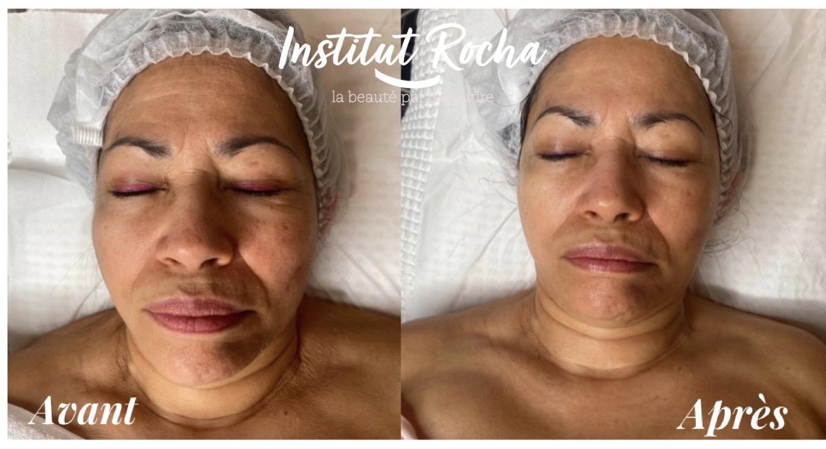 Meta thérapie (anti-âge) Résultats dès la première séance.