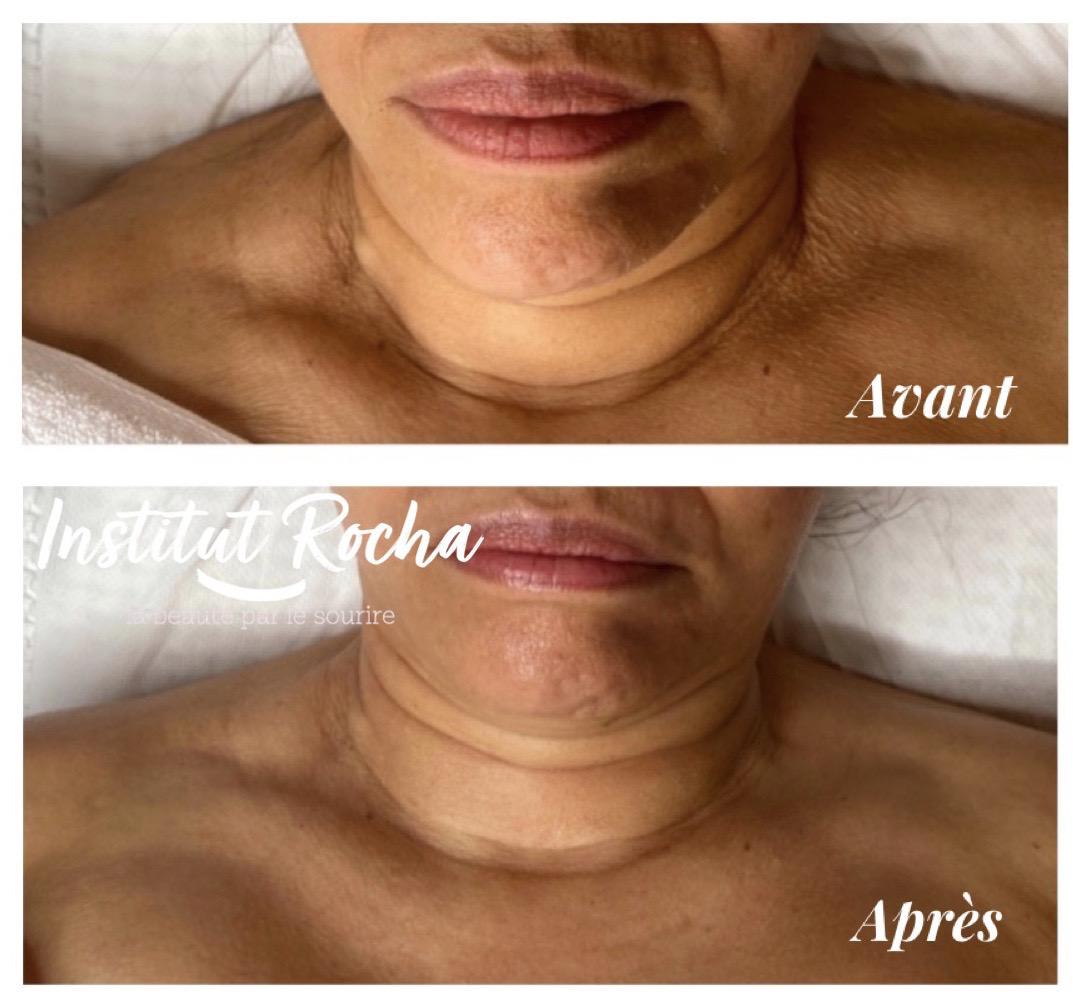 Dermatude: Résultat décolleté (même séance)