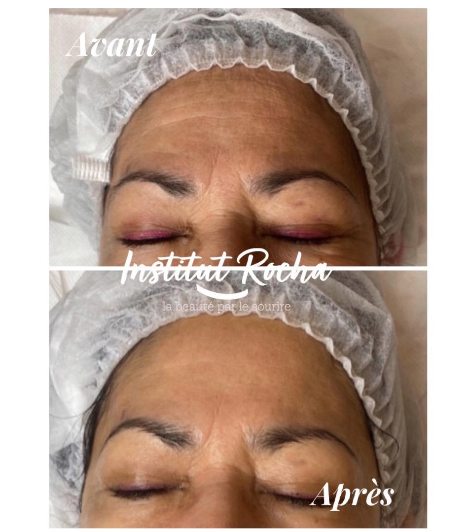 Dermatude: résultat front (même séance)