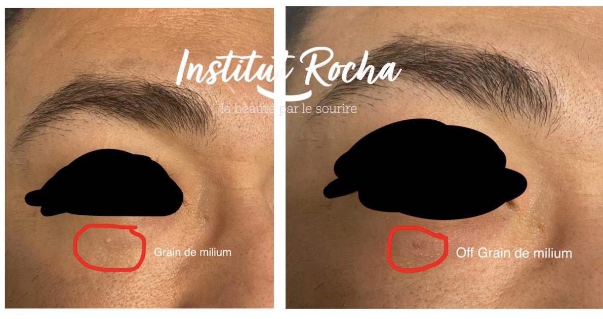 Elimination quiste de milium