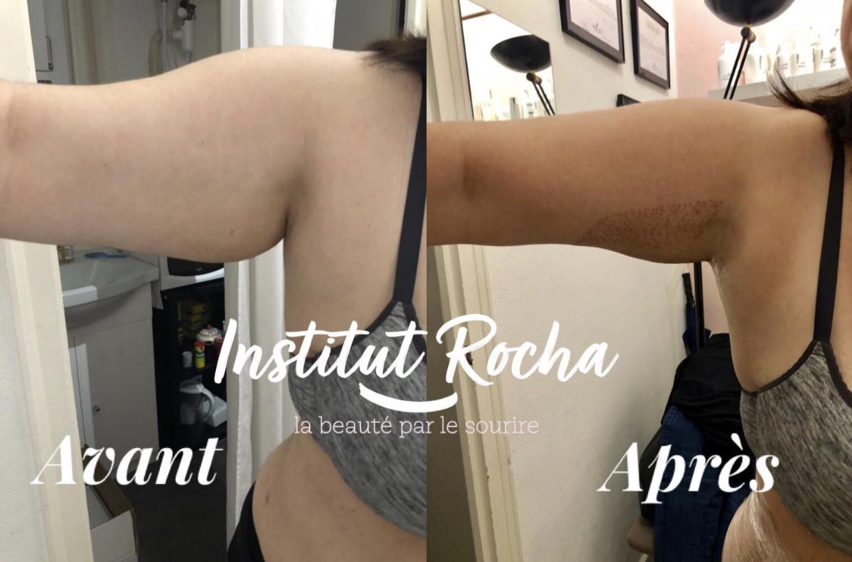 Soin peeling electrique